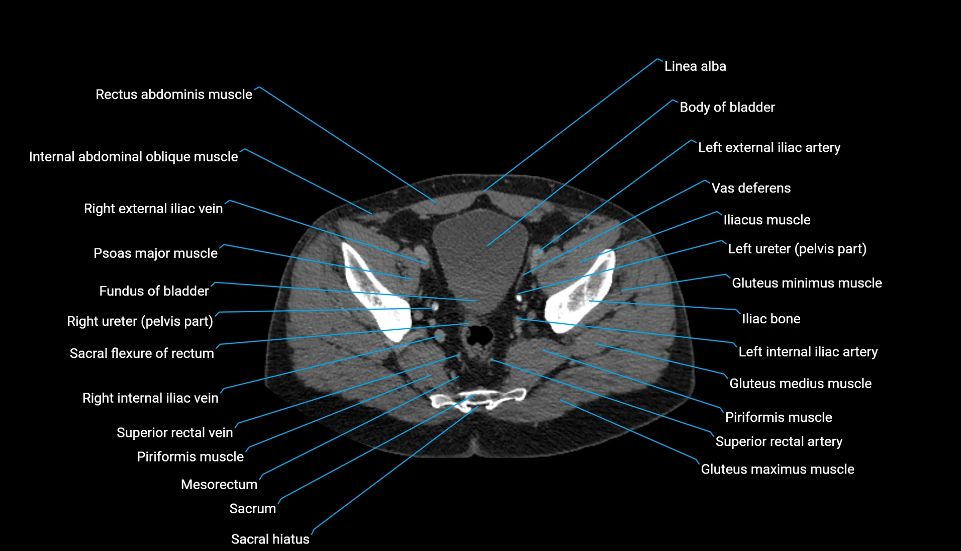 CT urogram axial cross sectional anatomy  labelled radiology image-00207.webp